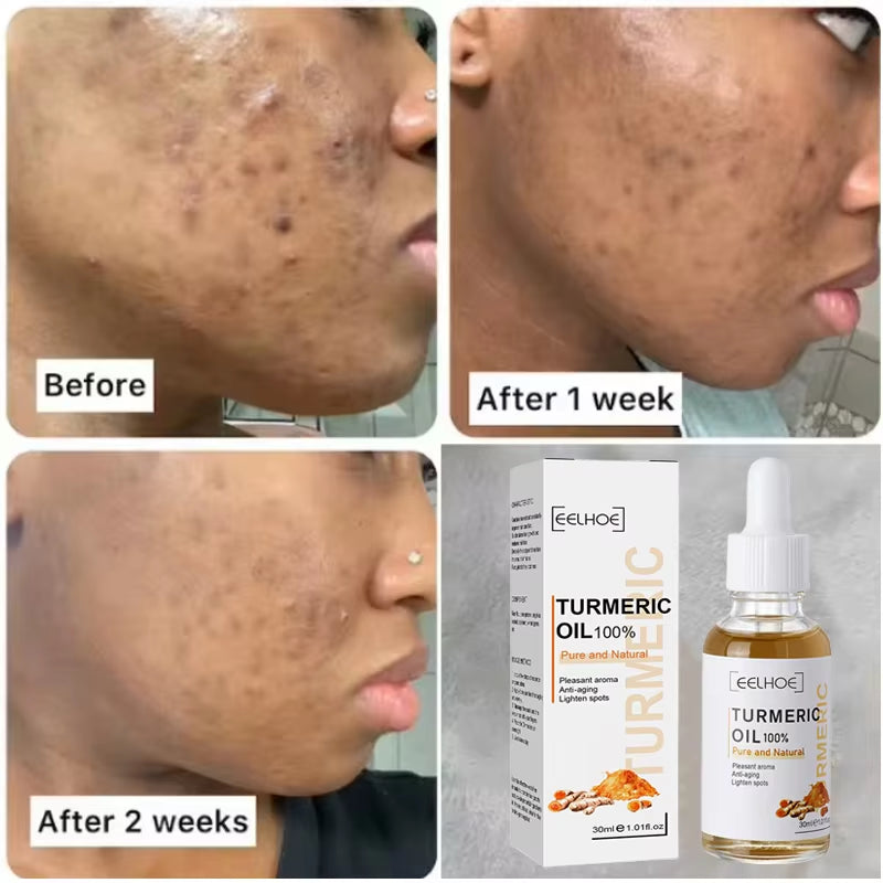 Dark Spot Remover Serum Turmeric Oil Whitening Freckle Facial Serum Anti-Aging Reduce Fine Lines Lighten Spots Melanin Skin Care